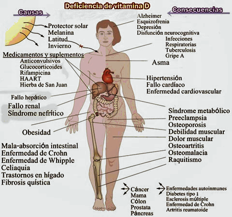 deficiencia-de-vitamina-D