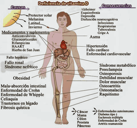 deficiencia-de-vitamina-D